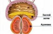 Аденома простаты. Причины и лечение