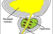 Хронический простатит и бесплодие – их взаимосвязь и последствия